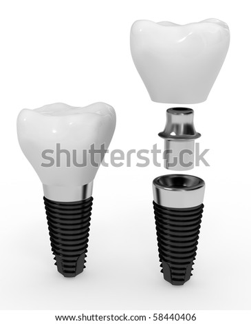 dental implant and its elements