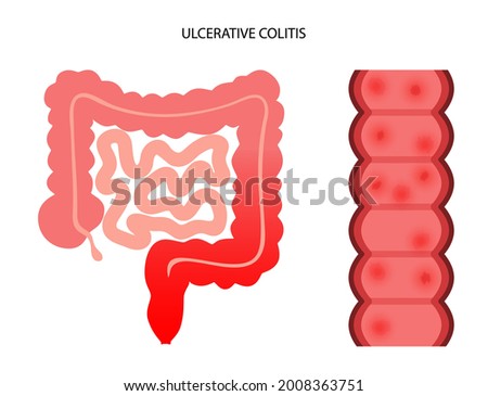 Ulcerative colitis concept. Inflammatory bowel disease. Ulcer and inflammation of the digestive tract, abdominal pain, colon problem in human body. Intestine anatomical poster flat vector illustration