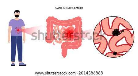 Cancer in small intestine. Gastrointestinal stromal tumor concept. Development of disease in the digestive system. Pain and inflammation in human body. Internal organs exam flat vector illustration.