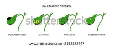 Gallbladder diseases infographic. Gallstone, cancer, acute cholecystitis, PSC or polyps the digestive system. Biliary ducts problems. Common cause of abdomen inflammation, flat vector illustration.