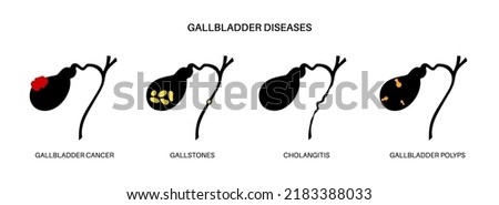 Gallbladder diseases infographic. Gallstone, cancer, acute cholecystitis, PSC or polyps the digestive system. Biliary ducts problems. Common cause of abdomen inflammation, flat vector illustration.