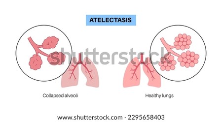 Atelectasis disease anatomical poster. Complete or partial collapse or closure of a lung. Reduced or absent gas exchange. Lungs filled with alveolar fluid. Respiratory system flat vector illustration