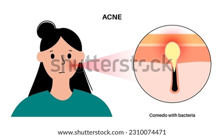 Acne treatment concept. Dead cells and oil from the skin clog hair follicles. Whiteheads and pimples, bacteria in comedo. Skin layers diagram, epidermis, dermis and hypodermis vector illustration.