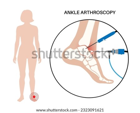 Ankle arthroscopy procedure. Feet joint minimally invasive surgery concept. Arthroscope and arthroscopic instrument. Foot treatment, leg pain and inflammation. Anatomical x ray vector illustration