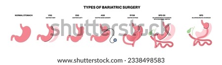Types of bariatric surgery. Healthy stomach and internal organs after operation, weight loss gastric procedure. Abdomen laparoscopy concept. Overweight and obesity problem flat vector illustration