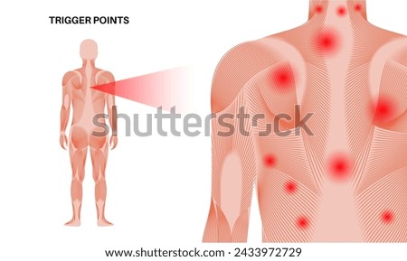 Myofascial trigger points medical poster. MTrPs concept. Hyperirritable spots in the skeletal muscle knots in male silhouette. Red points in sensitive areas on the human body flat vector illustration
