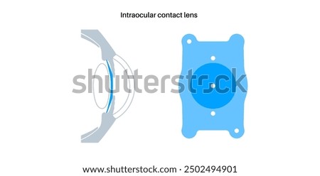 Lens implantation poster. Nearsightedness and astigmatism treatment, healthy eye with minimally invasive procedure EVO ICL. Human visual system anatomy. Cataract surgery flat vector flat illustration