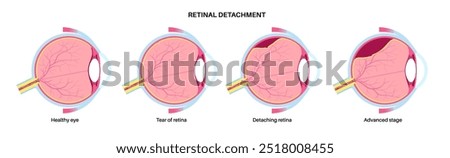 Retinal detachment anatomical poster. Human eye diseases concept, retina tissue problem. Vision loss and blindness, eye floaters and flashes and darkening side vision medical vector illustration.