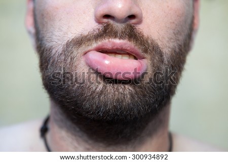 Male lip swollen due to  bee sting