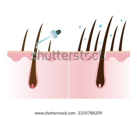 Increase hair density treatment with scalp layer vector isolated on white background. Treat loss, thin hair and fall and make thicker. Hair care concept illustration. 