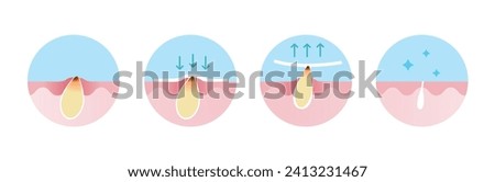 Step of blackhead removal vector icon set illustration isolated on white background. Cross section of blackhead treatment process, apply, peel off, unclogging and tighten pore. Skin care concept.