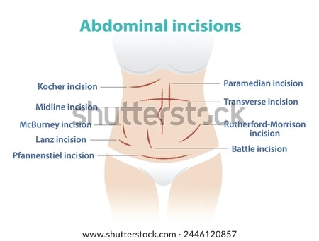 Types of abdominal incision for surgery vector illustration isolated on white background. Kocher, Midline, McBurney, Lanz, Pfannenstiel, Paramedian, Transverse, Rutherford Morrison, Battle incision.