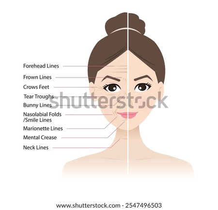 Comparison before and after facial wrinkles on woman face vector illustration. Forehead, Bunny, Marionette, Frown lines, Mental crease, Crows feet, Tear troughs, Nasolabial folds, Smile, Neck lines.