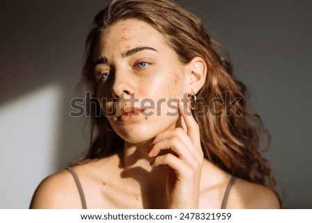 Similar – Image, Stock Photo Acne and acne spot on oily face skin of Asian woman. Concept before acne treatment and face laser treatment for get rid of dark spot post-acne. Closed comedones and open comedones on facial skin