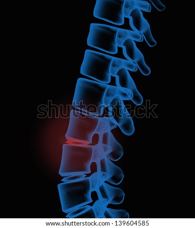 Pain in Lumbar vertebrae