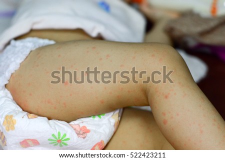 children rashes on legs
