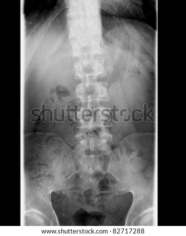 X-Ray Of The Lumbar Spine That Curves Into The Sacrum. Stock Photo ...