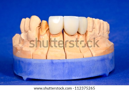 plaster cast with dental bridge and stump