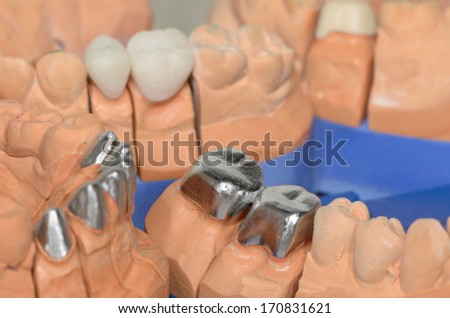 half finished dental crowns, metal caps on plaster cast