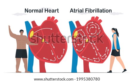 Data comparison of Normal heart and Atrial fibrillation. AF is common type of irregular heartbeat. Electrical signals in atrium cause atrium to beat quickly and erratically. cardiology vector.