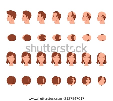 Stages of Baldness of Men and Women. Male and Female Characters Head Top, Side and Front View with Hair Loss Process, Health and Aging Problems, Transplantation. Cartoon People Vector Illustration
