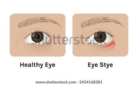 Realistic human healthy eye and with stye vector illustration design. Red inflammation, anatomy, health.