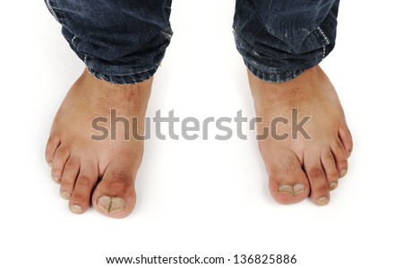 Deformed Male Feet Stock Photo 136825886 : Shutterstock