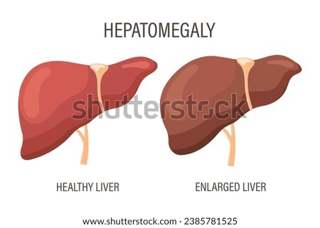 Hepatomegaly, liver diseases. Healthy liver and enlarged liver. Medical infographic banner. Vector