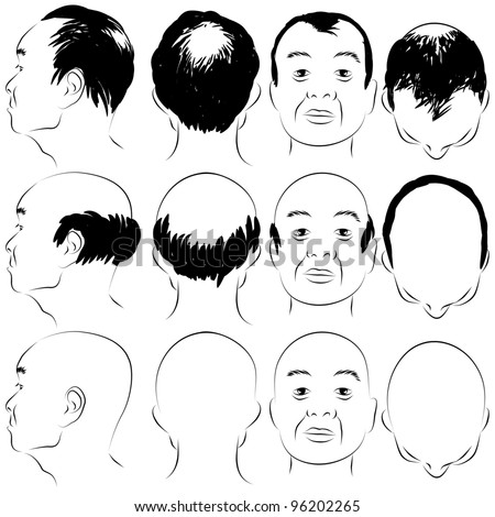 Genetic associations for early onset of male pattern baldness found