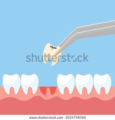 Extracted tooth decay pull out sick tooth Stock foto © 