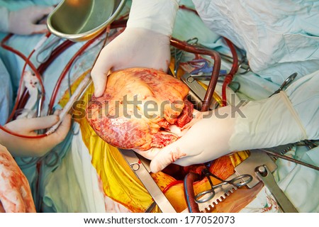 Heart transplantation. Human heart in surgeon hands during cardiac surgery operation