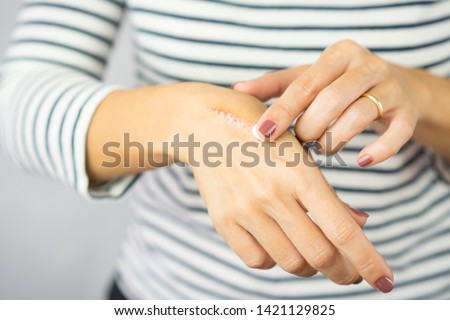 A woman applying scars removal cream to heal the first degree - heat burn wound on her hand. Healing, Removal, treatment, Hot oil burn, Vitamin E, Scars care, Skin care products, Medical cream, Repair Foto d'archivio © 