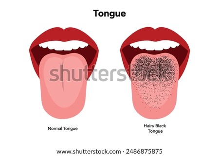 Hairy black tongue, medical information