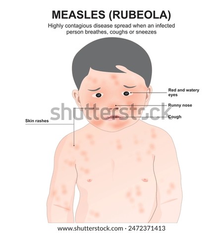 Similar – Image, Stock Photo Measles or rubeola rash on Caucasian man’s skin