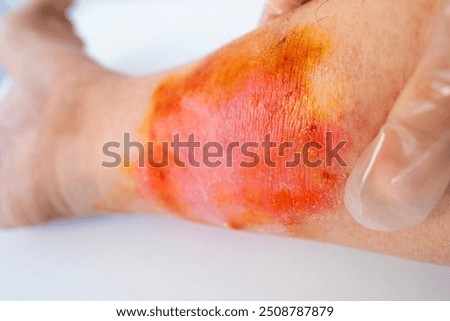 Similar – Image, Stock Photo scratch wound on female hand closeup, healthcare and medicine concept