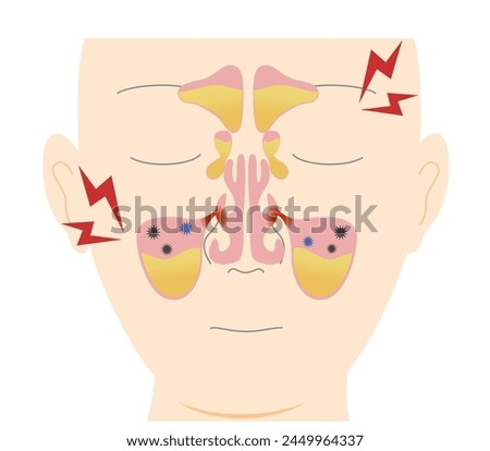 How and why chronic sinusitis occurs