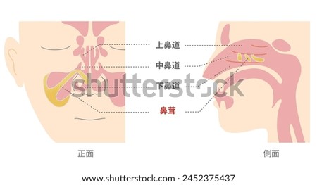 Illustration of nasal polyps in the sinuses from front and side views [TRANSLATE];Nasal polyps, Superior meatus, Middle meatus, 
Inferior  meatus, 