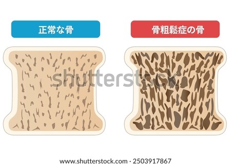 Comparison of cross-sectional views of osteoporotic and normal bone [Translate]osteoporotic bone, normal bone