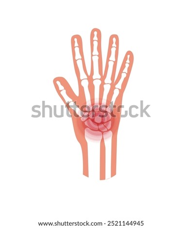 Pain and inflammation in hand on x ray. Rheumatoid arthritis symptom on human joints and bones. Skeleton scan concept. Finger disease flat vector illustration. Banner, poster for clinic and hospital