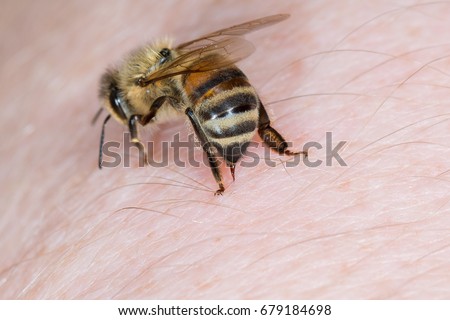 Bee stings in the hand of a person Imagine de stoc © 