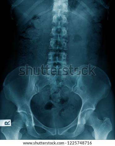 x-ray image of human spine show degenerative change of spine bone and disc  Stock fotó © 