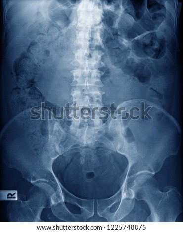 x-ray image of human spine show degenerative change of spine bone and disc  Stock fotó © 