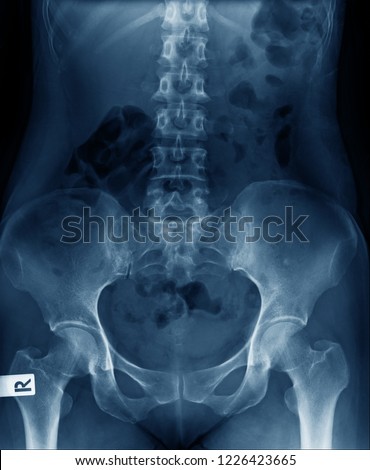 x-ray image abdominal and pelvic bone with thoraco-lumbar spine  Stock fotó © 