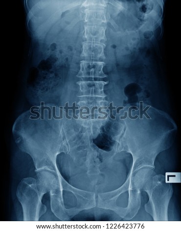 x-ray image abdominal and pelvic bone with thoraco-lumbar spine  Stock fotó © 