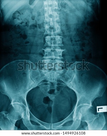 x-ray image lumbar spine and degenerative change of spine, l-spondylosis x-ray image in blue tone Stock fotó © 