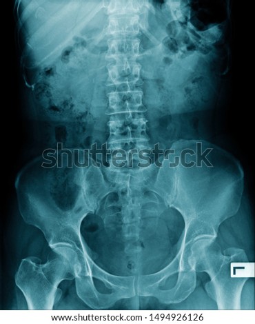 x-ray image lumbar spine and degenerative change of spine, l-spondylosis x-ray image in blue tone Stock fotó © 