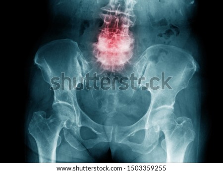 spondylosis x-ray image, x-ray image of compression fracture  L4-5 of human spine Stock fotó © 