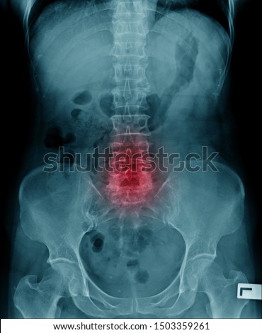 spondylosis x-ray image, x-ray image of compression fracture  L4-5 of human spine Stock fotó © 
