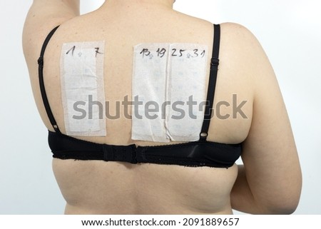 Patch tests stuck on the back of a woman, Tests for skin allergens, metals, preservatives, fragrances, drugs, glue, gums, synthetic resins, natural, dental materials, dyes  Photo stock © 