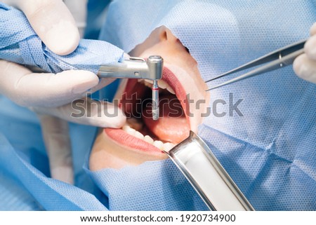 Close-up shot of attentive doctors performing surgical operation installing dental implants into patient's mouth in modern dental clinic. Dental instruments. Stomatology clinic. Dental surgery. Stockfoto © 